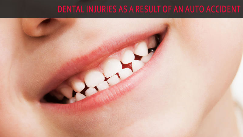 Dental Injuries As a Result of An Auto Accident